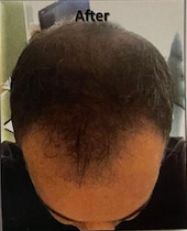 Result snap shot of man's hair after the hair regrowth treatment therapy