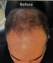 snapshot of man's hair before the hair regroqth treatment therapy